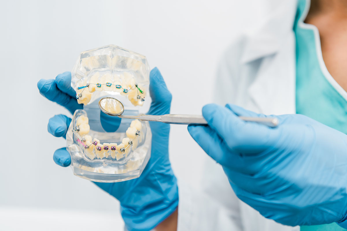 dental jaw model with braces Orangevale Dental jaw model shown to patient during free orthodontic consultation Orangevale