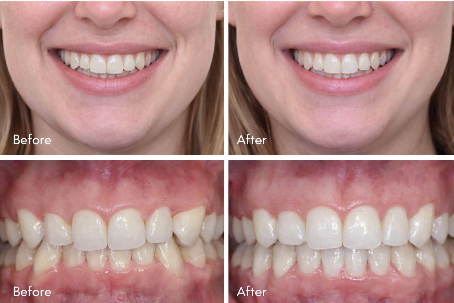 Invisalign Before and After – Real Smile